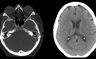 Низкодозовая КТ